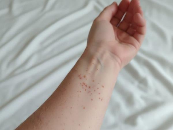 Suben a cuatro los casos de sarampión en Puebla; detectan contagios en Cholula y Chignahuapan